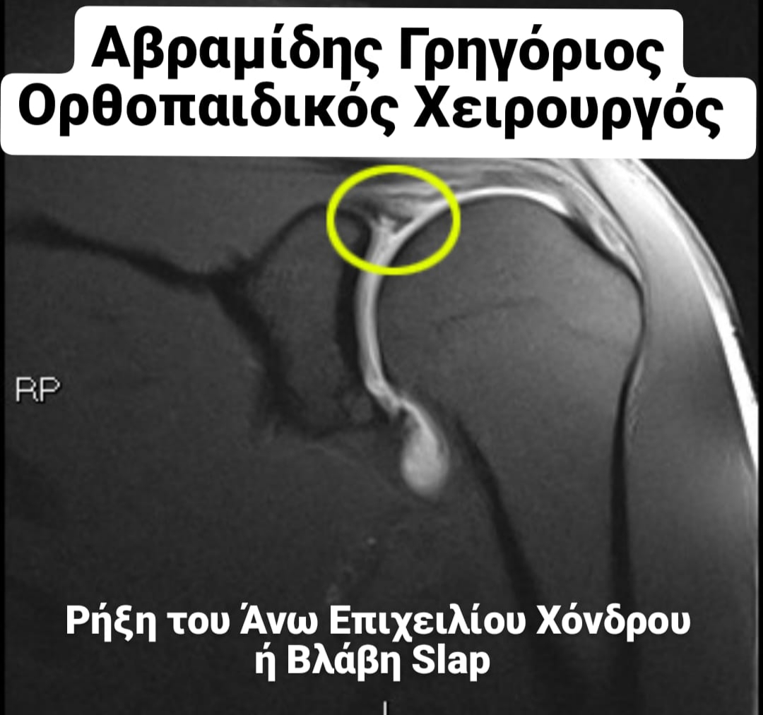 Διάγνωση Βλάβης SLAP